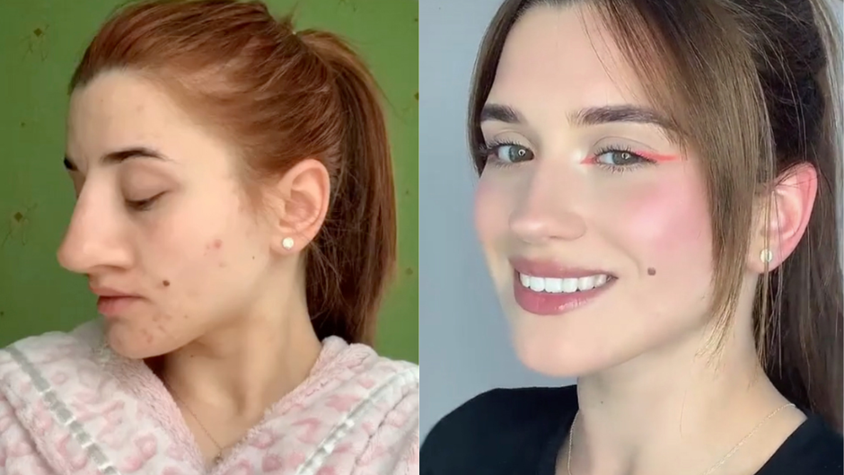 Žena dijeli nevjerojatne rezultate prije i poslije operacije nosa, a ljudi ne mogu vjerovati da je to ista osoba | Autor: TikTok@@NORCAL_BULLYBREED_RESCUE