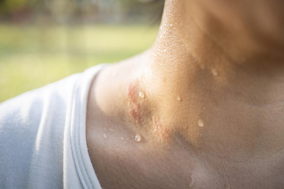 Domaći lijekovi protiv znojenja | Autor: Shutterstock