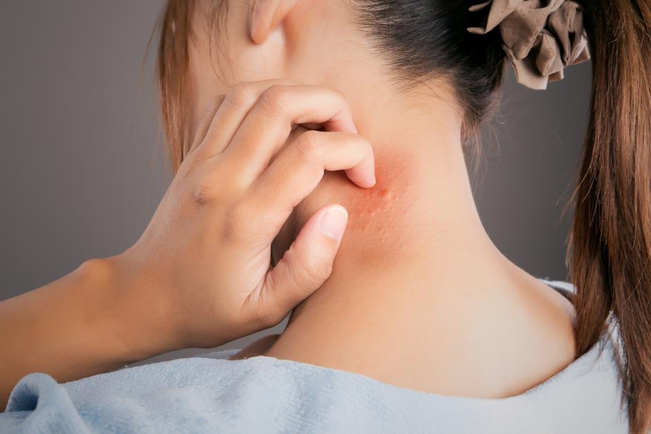Dermatitis | Autor: Shutterstock